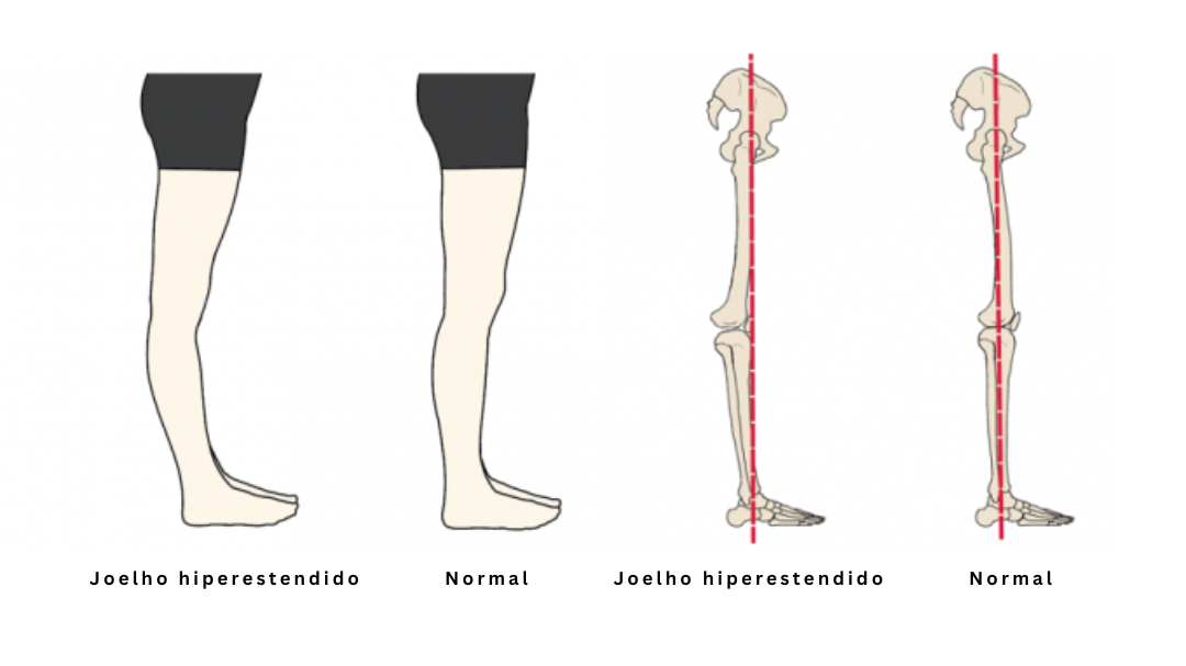Hiperextensão do joelho: Causas, Sintomas e Tratamento - Avantefisio