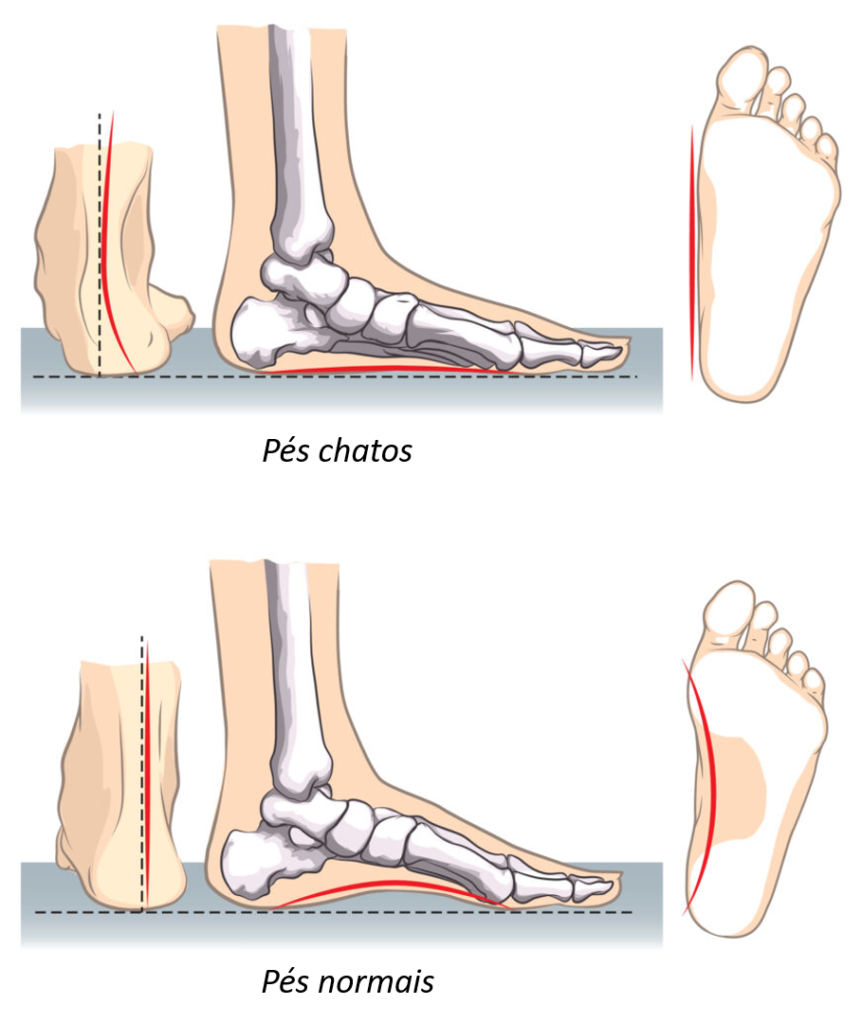 Pés chatos