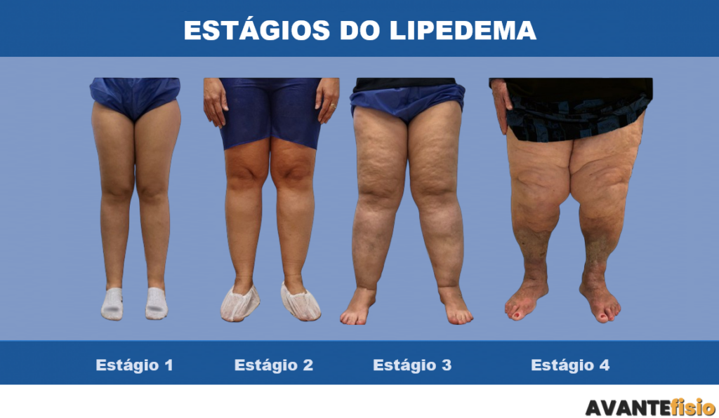 Estágios do lipedema