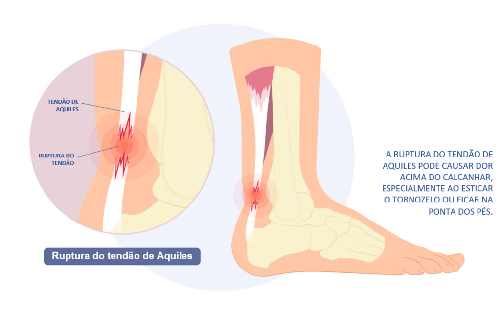 Ruptura do tendão de Aquiles