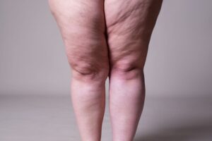 Lipedema