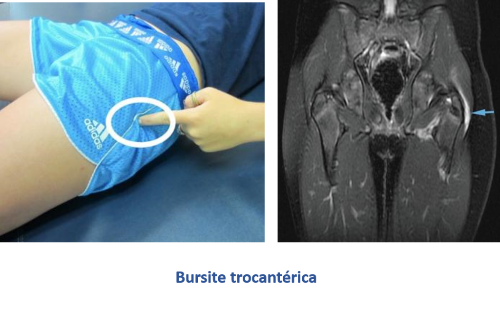 Bursite trocantérica
