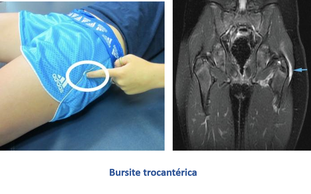 Bursite trocantérica