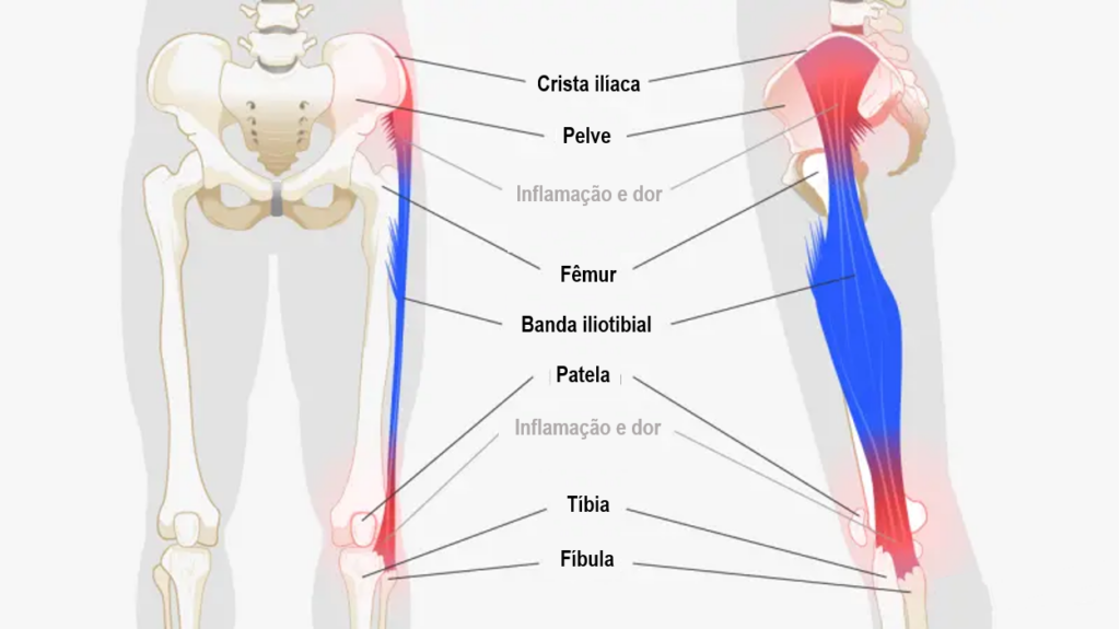 Síndrome da Banda Iliotibial