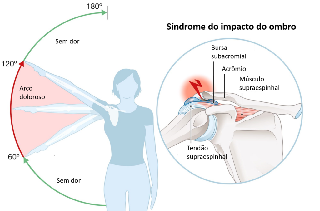 Síndrome do impacto do ombro