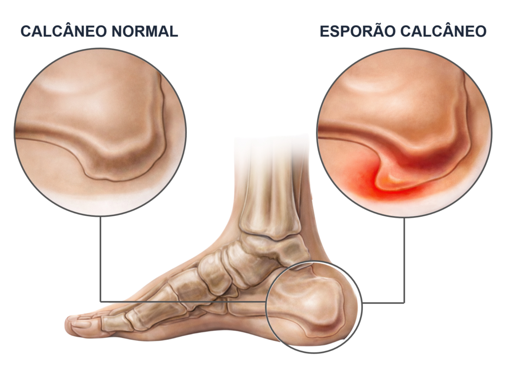 Esporão calcâneo: Causas, sintomas e tratamentos - Avantefisio